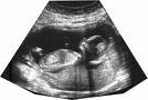 ultrasound